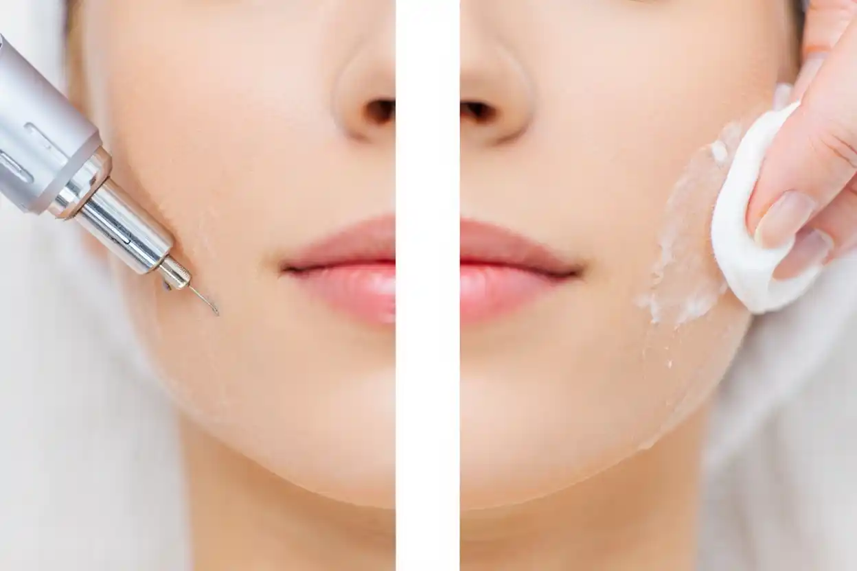 Soin combiné microneedling et peeling à Paris 19